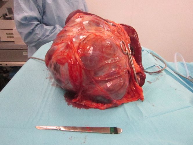 The resected splenic mass (scalpel visible as scale)